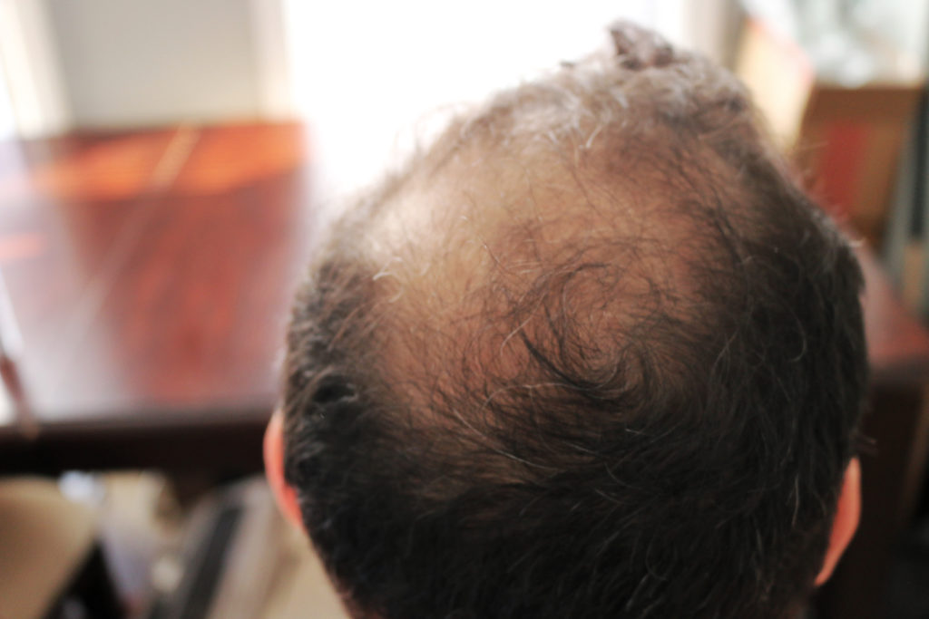 rogaine cause more hair loss